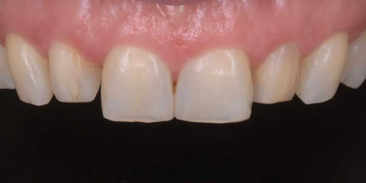 Caso Clínico 6 • Estética Dental Avanzada Antes