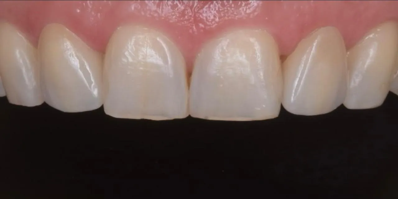 Caso Clínico 6 • Estética Dental Avanzada Después