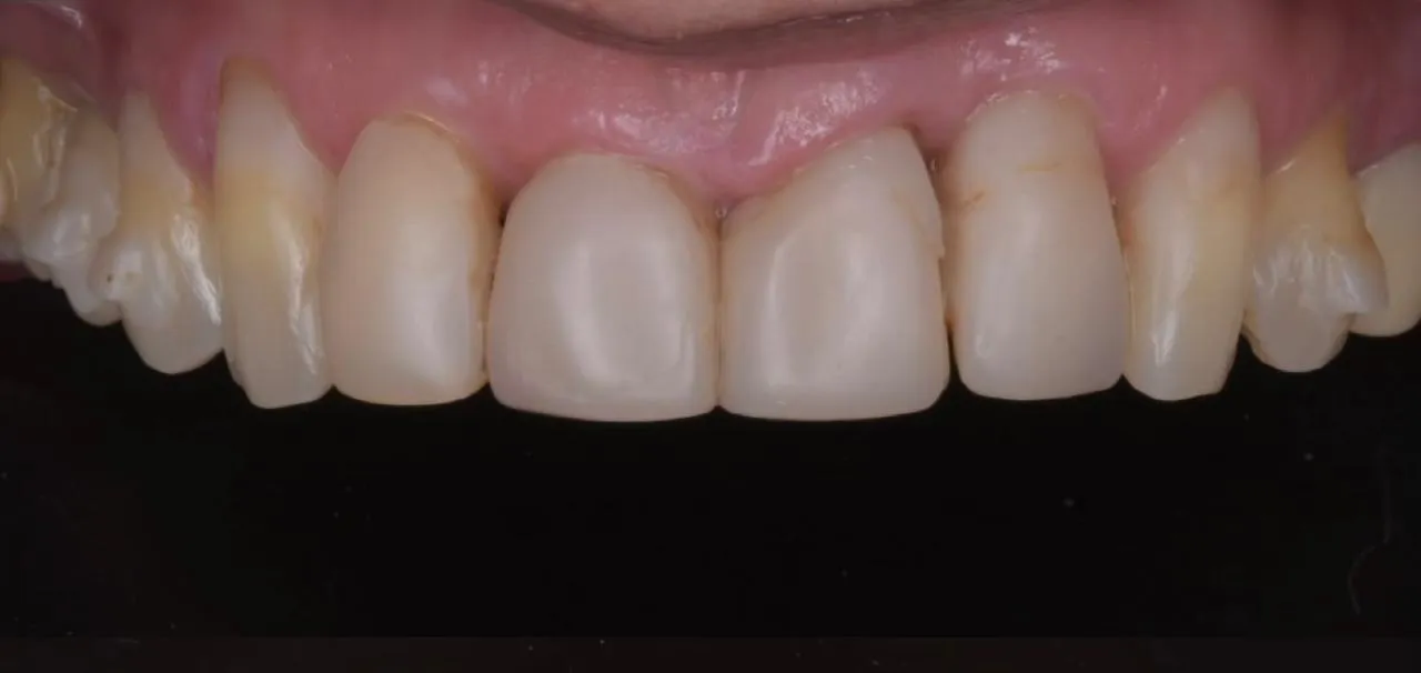 Caso Clínico 5 • Lentes de Contacto Dental Antes