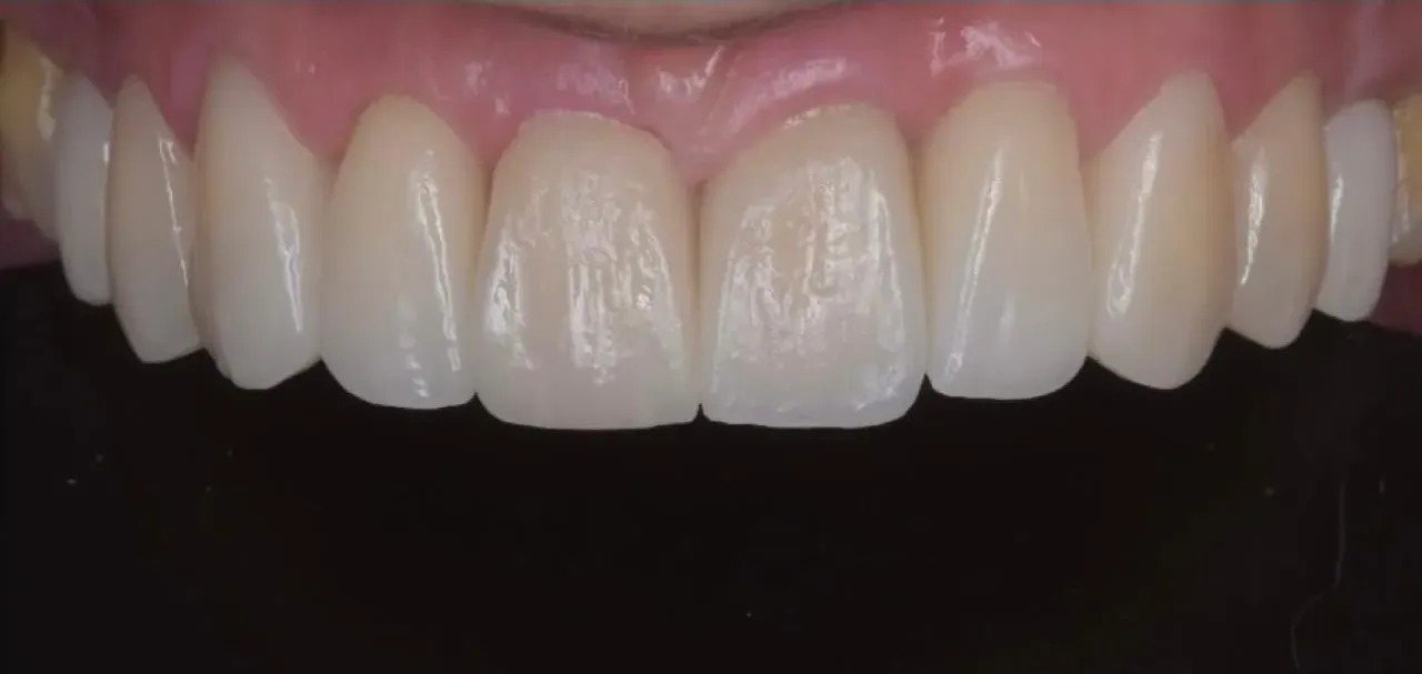 Caso Clínico 5 • Lentes de Contacto Dental Después