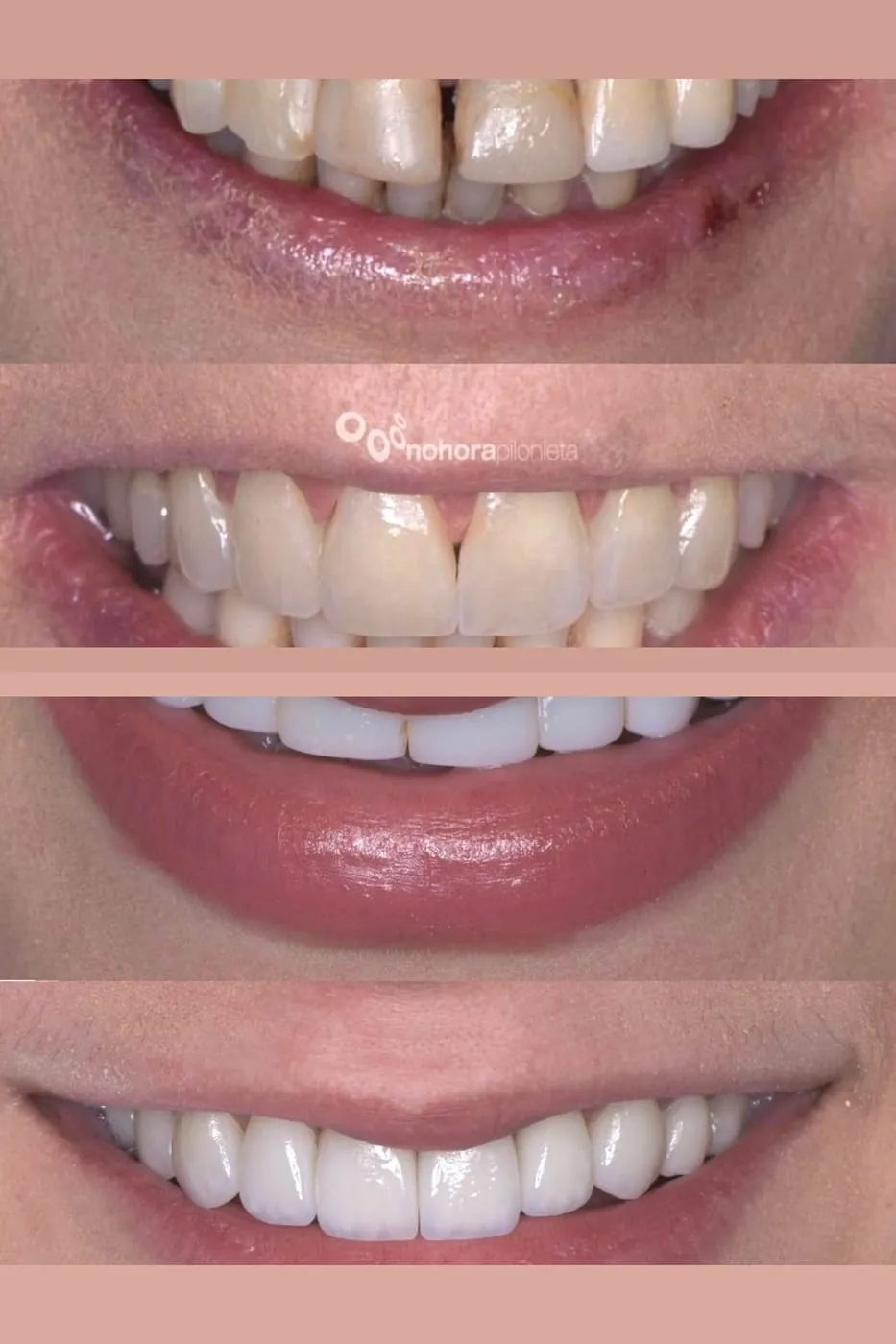 Estética Dental