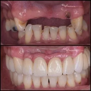 Implantología Oral