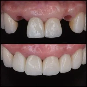Implantología Oral