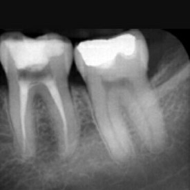 endodoncia2